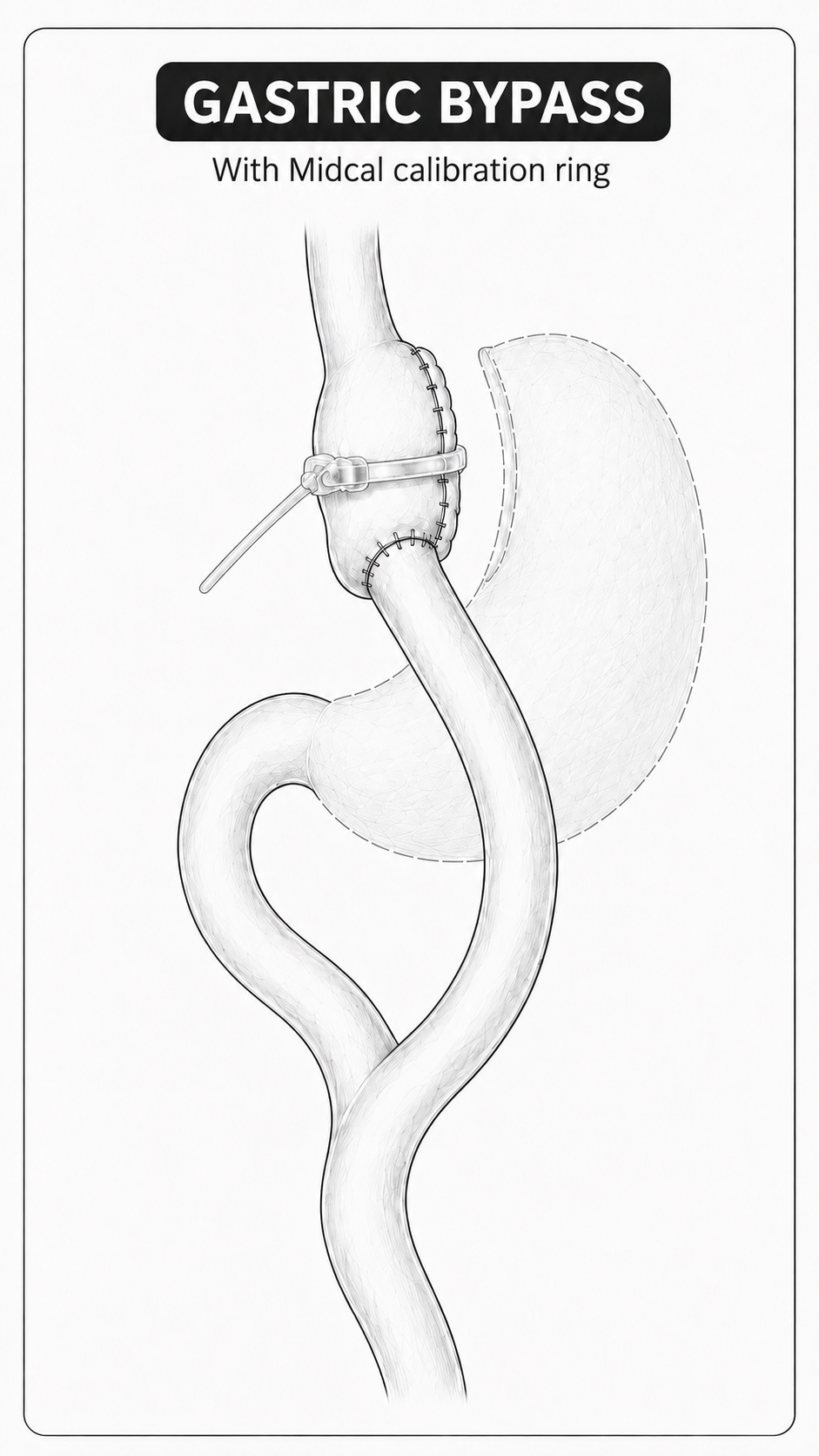 Gastric bypass with calibration ring diagram