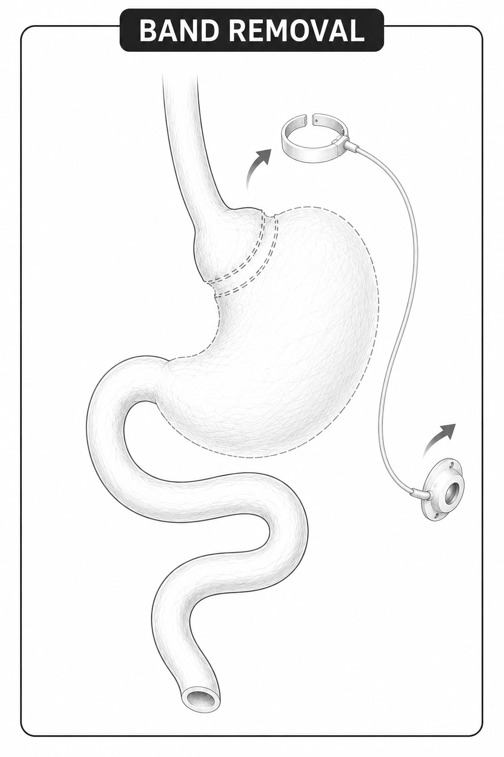 Gastric band removal diagram, band and port removed