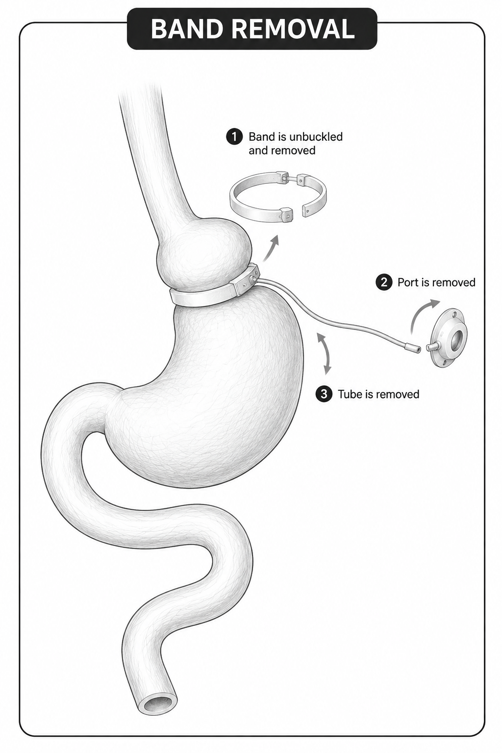 Gastric band removal diagram, step-by-step