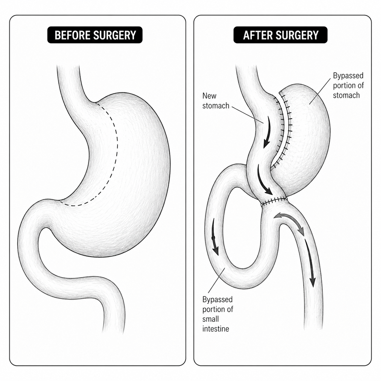 One anastomosis gastric bypass diagram