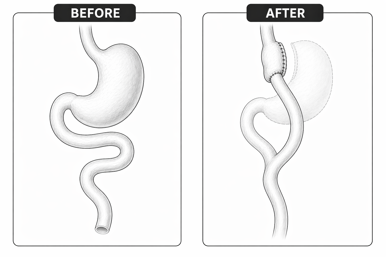 Roux-en-Y gastric bypass diagram