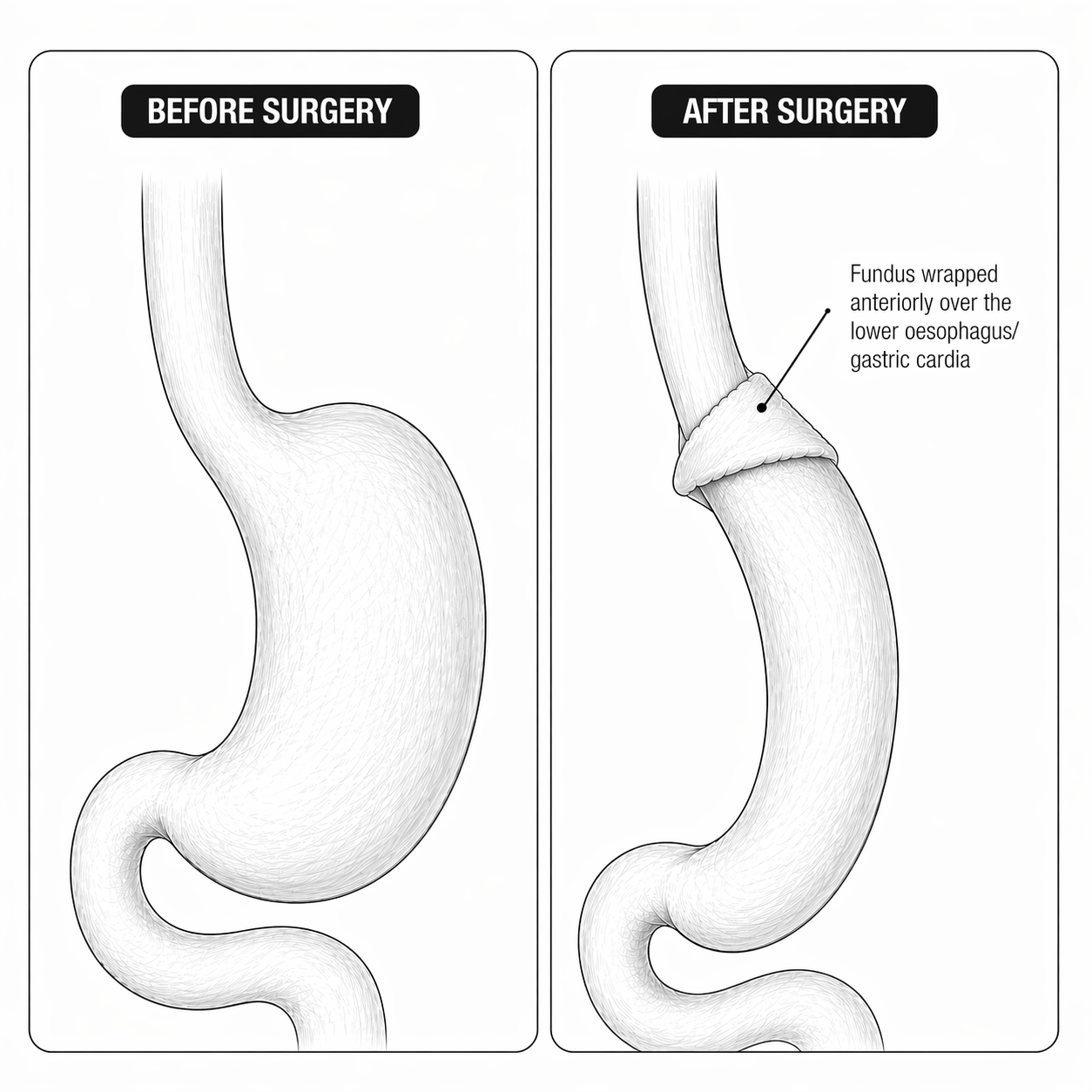 Sleeve fundoplication diagram